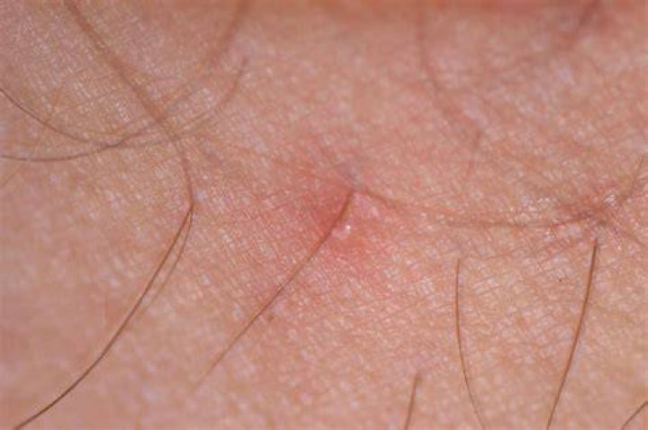Can Chiggers Burrow Beneath Your Skin?