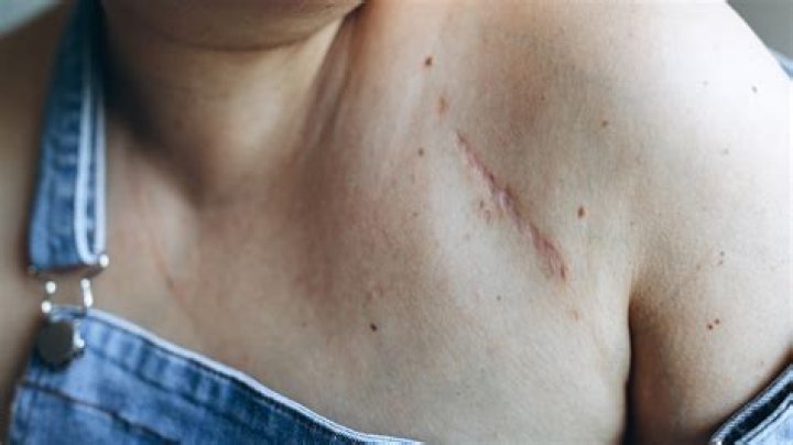 Unpacking the Scars Wonderland Leak: What It Means for Future Scar Care