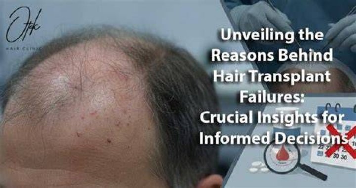 Unveiling Adam 22 Hair Transplant: Discoveries And Insights Revealed