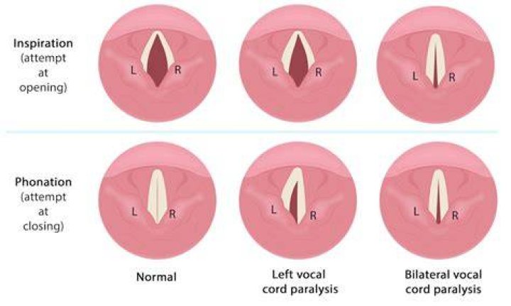 Unveiling Brandy Renee's Pre-Surgery Vocal Prowess: Discoveries And Insights